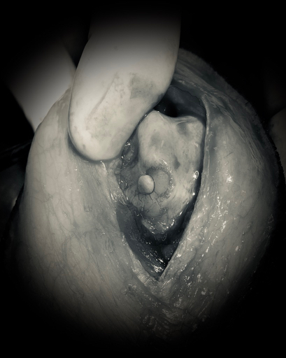 What is osteochondrosis?